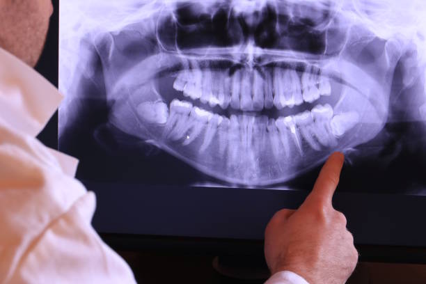 Best Dental Abscess Treatment in Scaggsville, MD