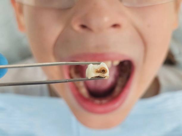 Best Emergency Treatment for Oral Infections in Scaggsville, MD